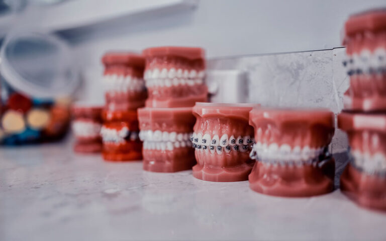 Dental models with metal and ceramic braces for patient reference at Blackburn Orthodontics
