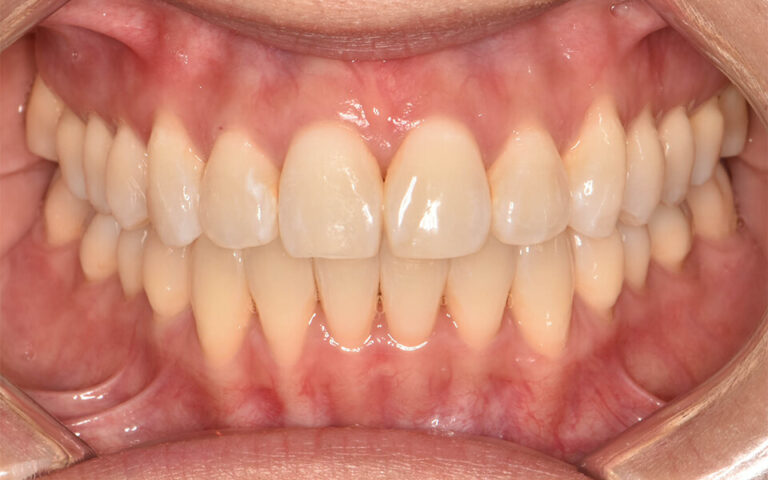 Mild anterior open bite, crowding Invisalign treatment at Blackburn Orthodontics